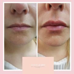 Aumento de Labios - Dra. Jimena Latorre