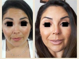 Resultado paciente con tratamiento de toxina botulínica 