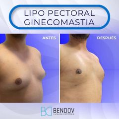 Ginecomastia - Clinica Bendov