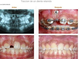 Traccion de un diente retenido