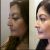 Rinoplastia hace un mes
