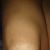 Tengo una cicatriz en la rodilla que me acompleja demaciado.