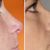 Rinoplastia Ultrasonica