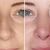 Rinoplastia Ultrasonica