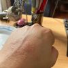 Tratamiento para sarpullido en la mano