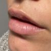 Bultos en labios tras aplicar ácido hialurónico