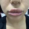 Complicación en relleno de labios con ácido hialuronico.