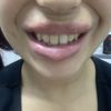 Complicación en relleno de labios con ácido hialuronico.