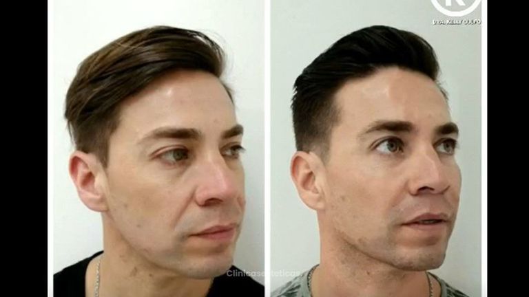 Armonización Facial