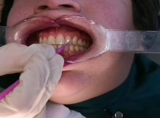 Tratamiento blanqueamiento dental